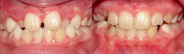 Anterior Crossbite (Early Partial Treatment)