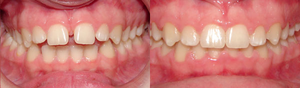 Crowding - Ectopic Eruption of Canines