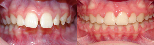 Ectopic Eruption of Canines