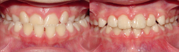 Interceptive Treatment (Early Partial Treatment)