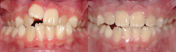 Posterior crossbite (Early Partial Treatment)